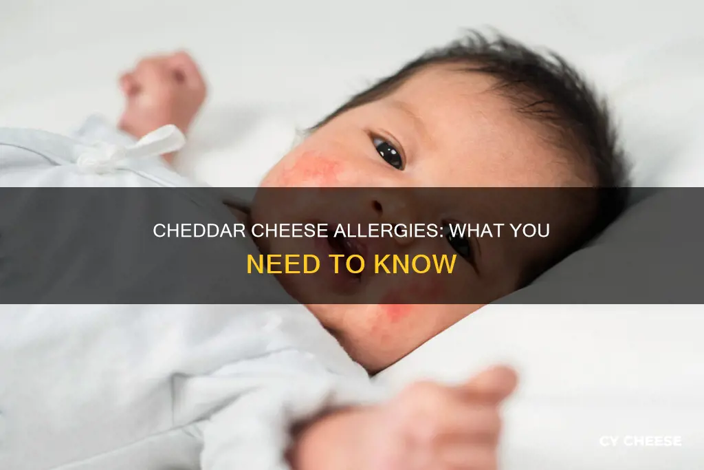 does cheddar cheese cause allergy