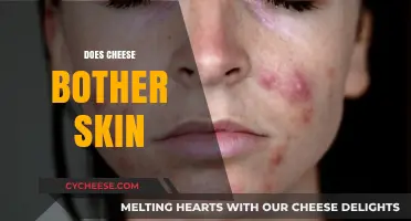 Does Cheese Cause Skin Issues? Unraveling the Dairy-Acne Connection