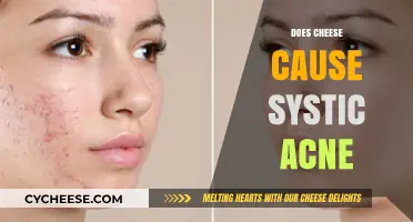 Cheese and Cystic Acne: Unraveling the Diet-Skin Connection
