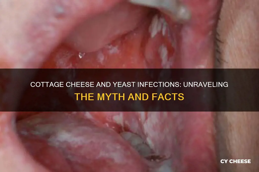 does cottage cheese cause yeast infections