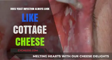 Does Yeast Infection Always Look Like Cottage Cheese? Debunking Myths