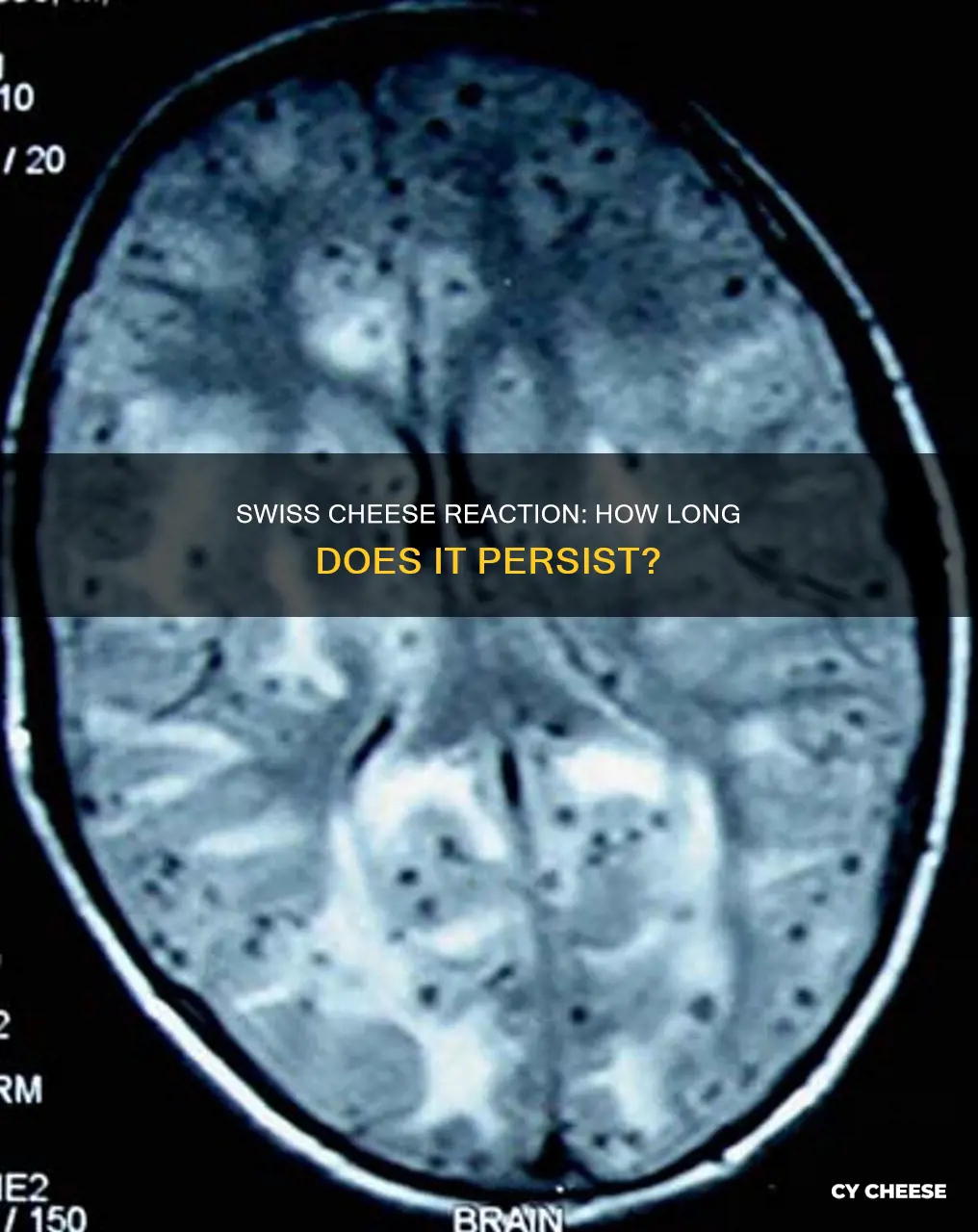 how long does swiss cheese reaction last