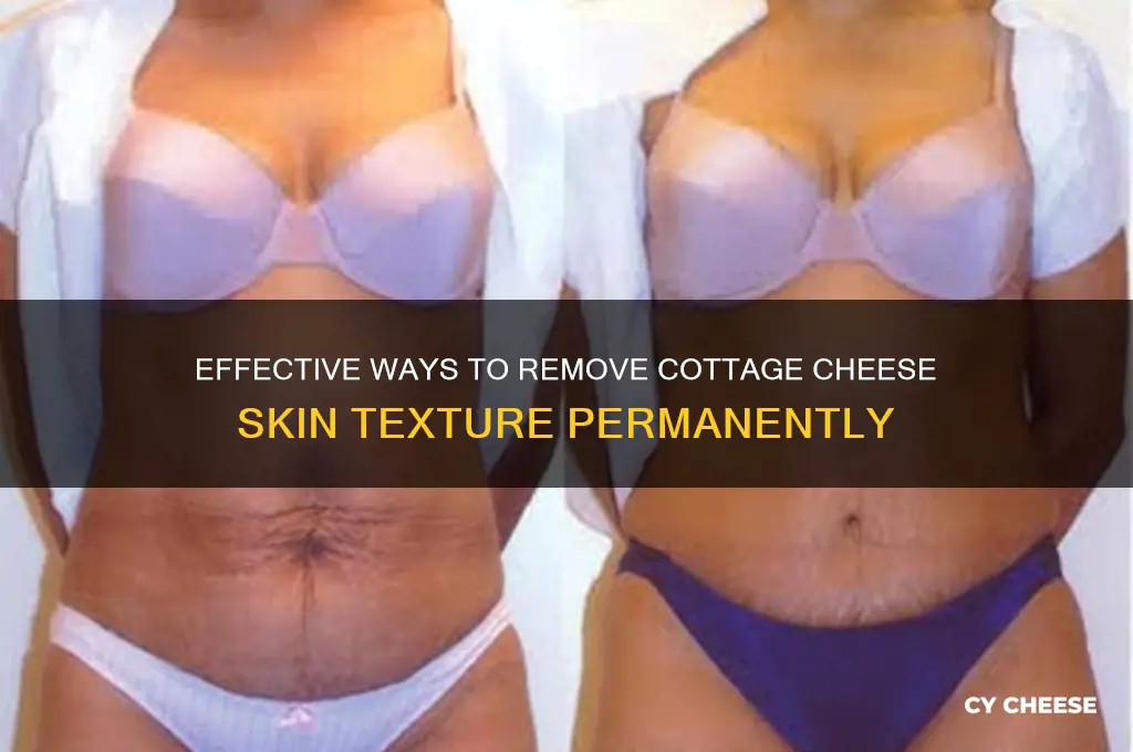 how to get rid of cottage cheese