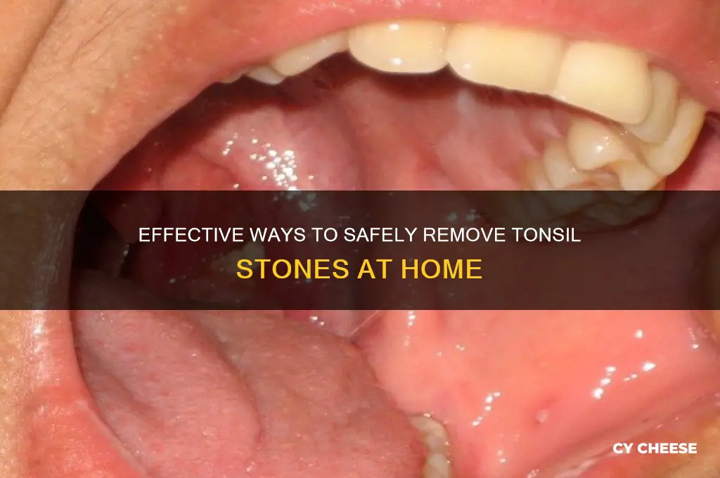how to remove tonsil cheese