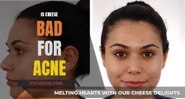Cheese and Acne: Is There a Connection?