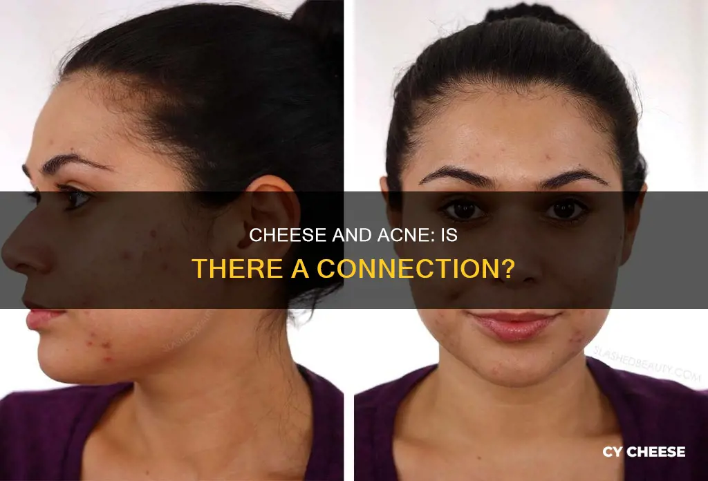 is cheese bad for acne