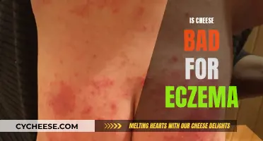 Cheese and Eczema: What's the Connection?