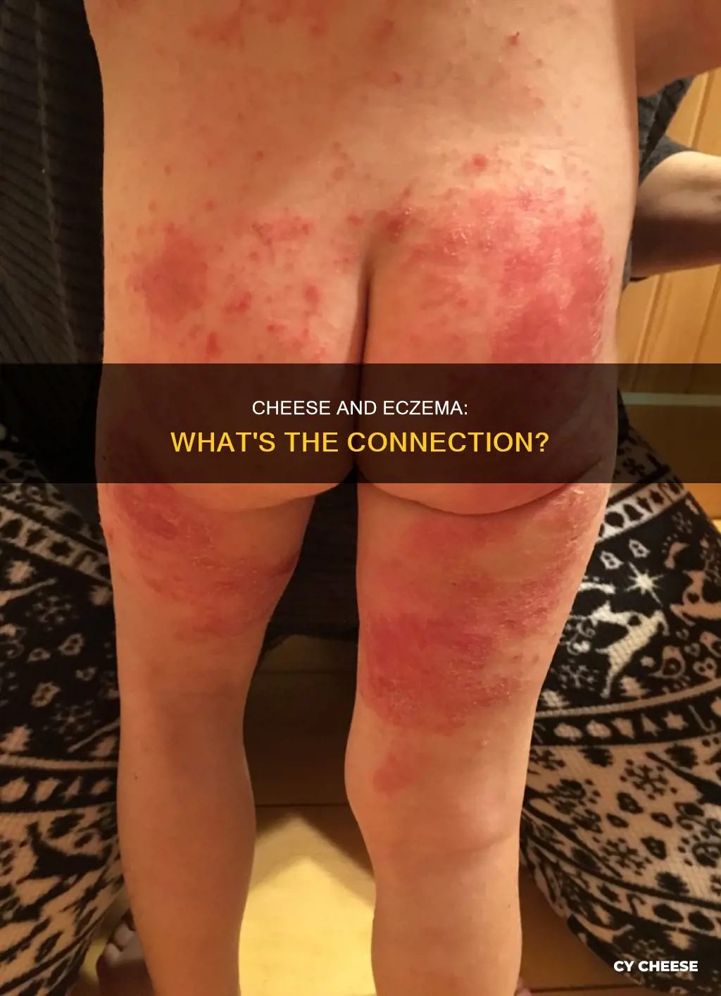 is cheese bad for eczema