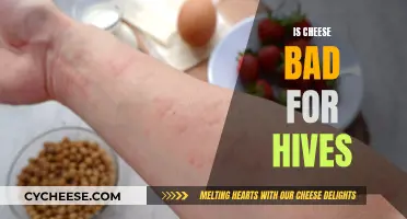 Cheese and Hives: What's the Connection?