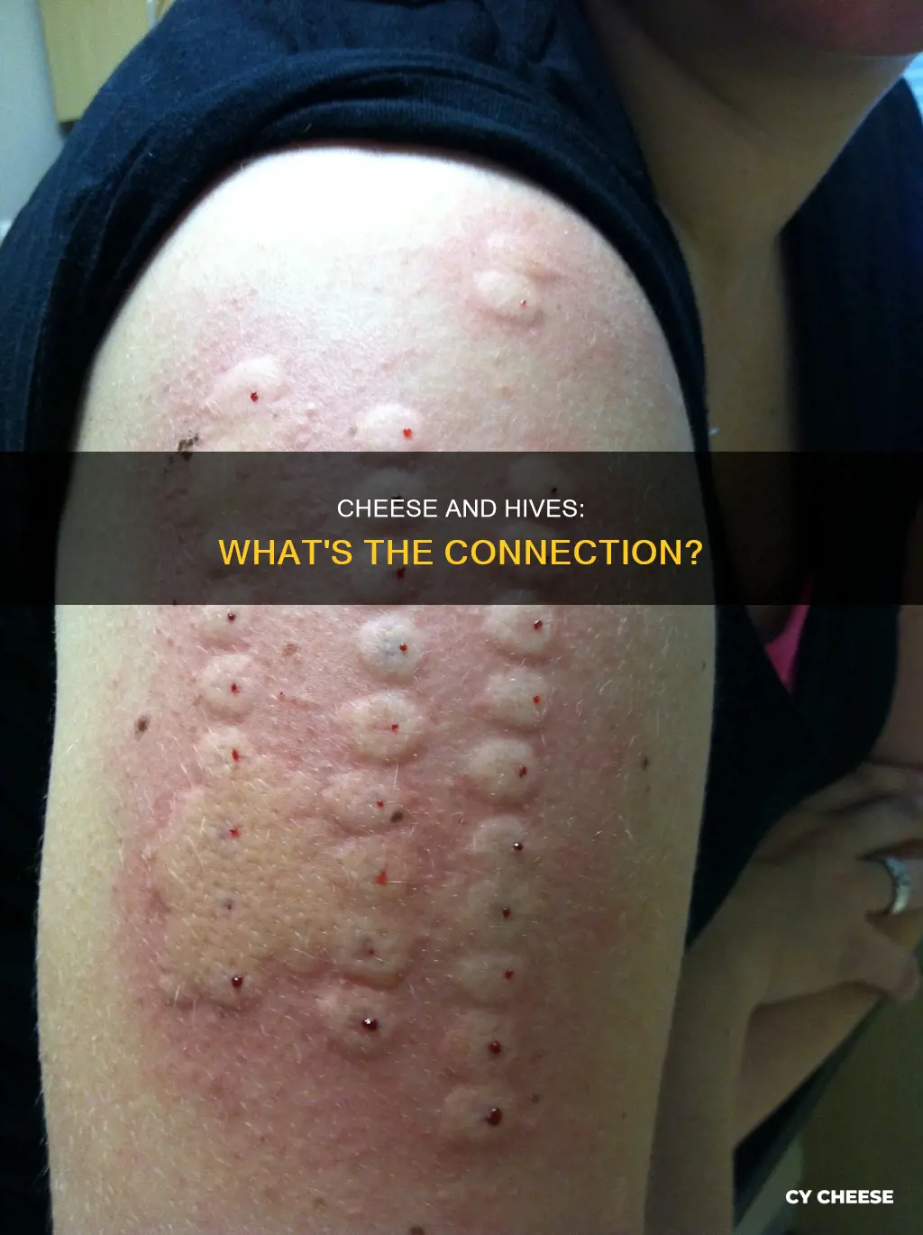 is cheese bad for hives