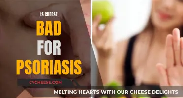 Cheese and Psoriasis: What's the Connection?
