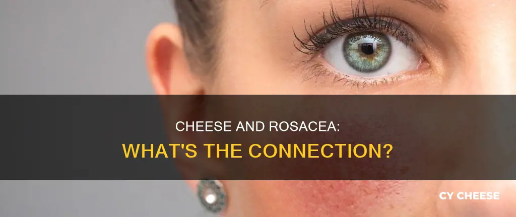is cheese bad for rosacea