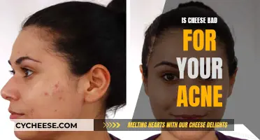 Cheese and Acne: What's the Real Deal?