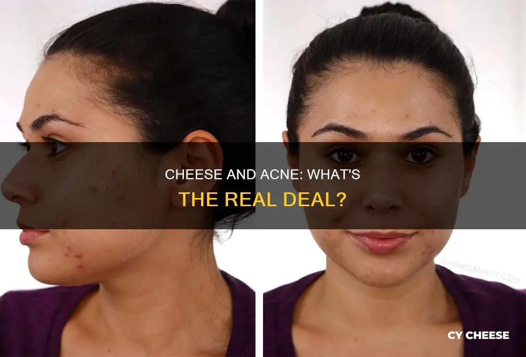 is cheese bad for your acne