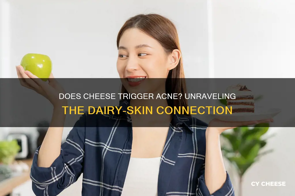 is cheese cause acne