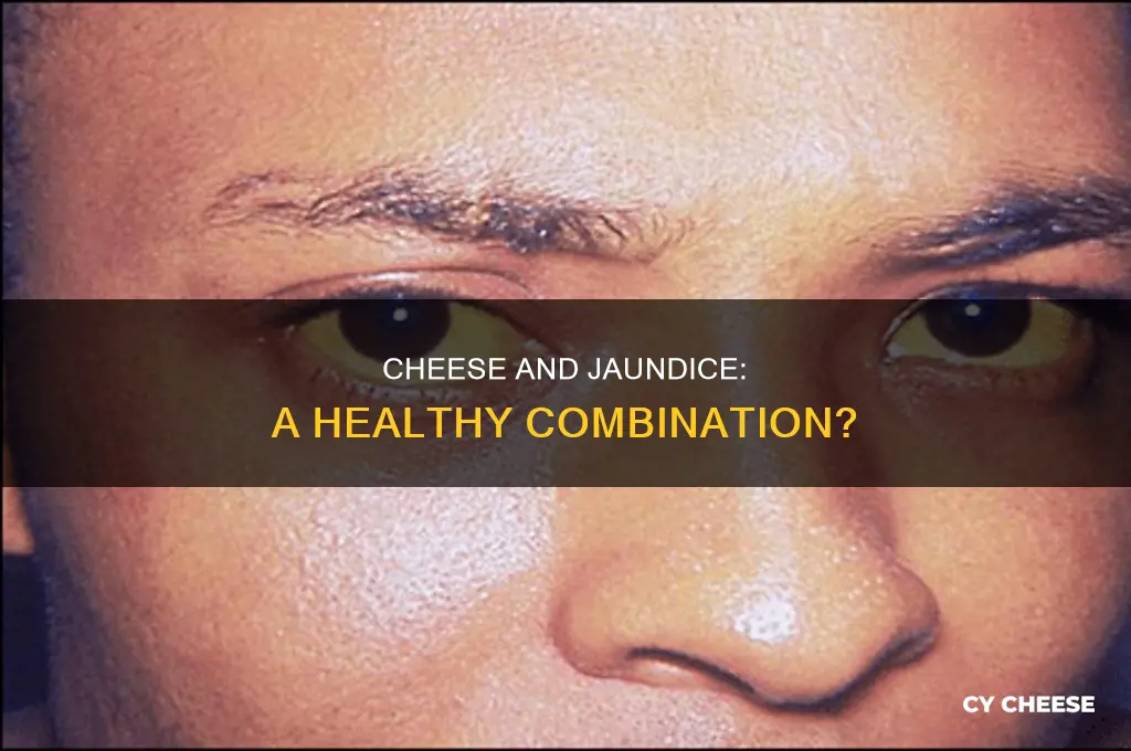 is cheese good for jaundice