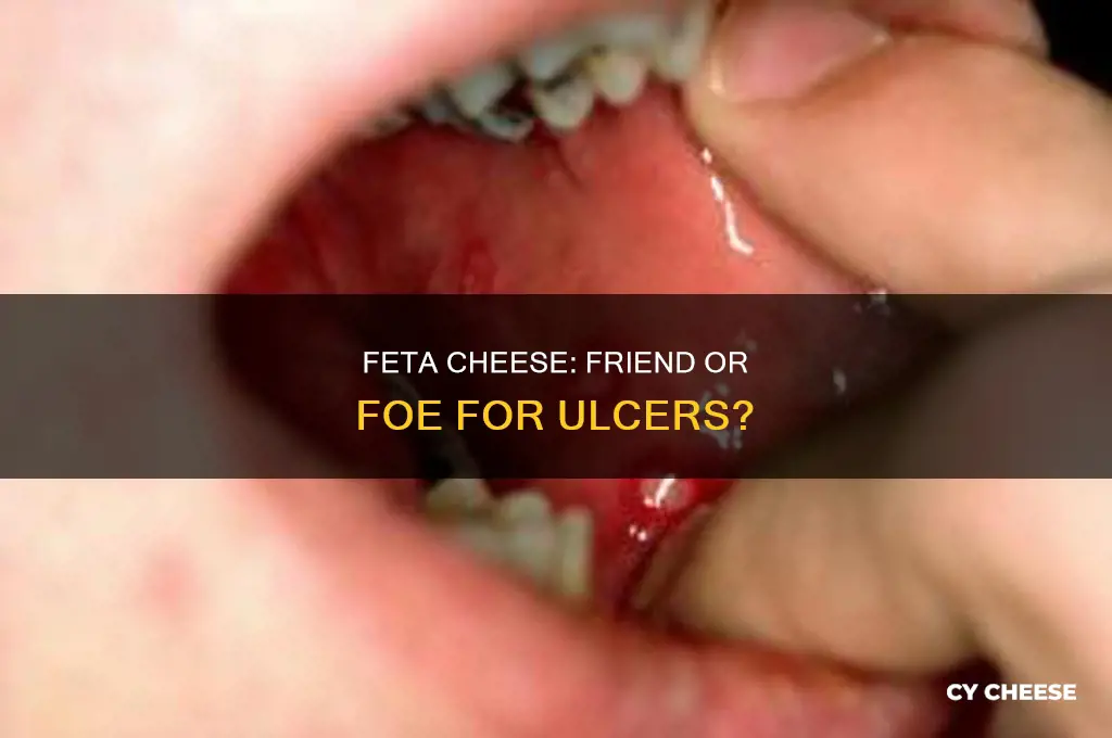 is feta cheese good for ulcers