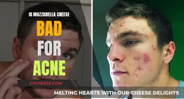 Mozzarella and Acne: Is This Cheese Bad for Your Skin?