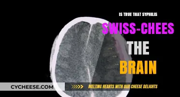 Syphilis: Brain Swiss-Cheese and You