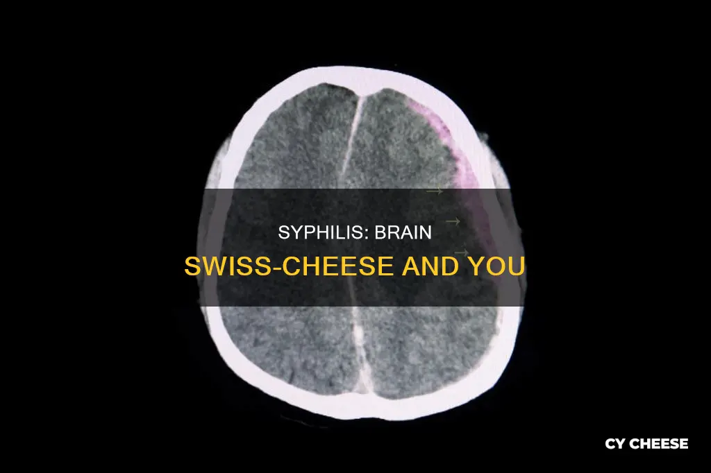 is true that syphilis swiss-cheeses the brain