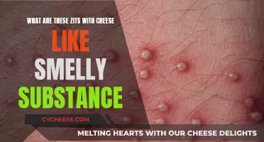 The Mystery of Zits: Cheesy, Smelly Substance