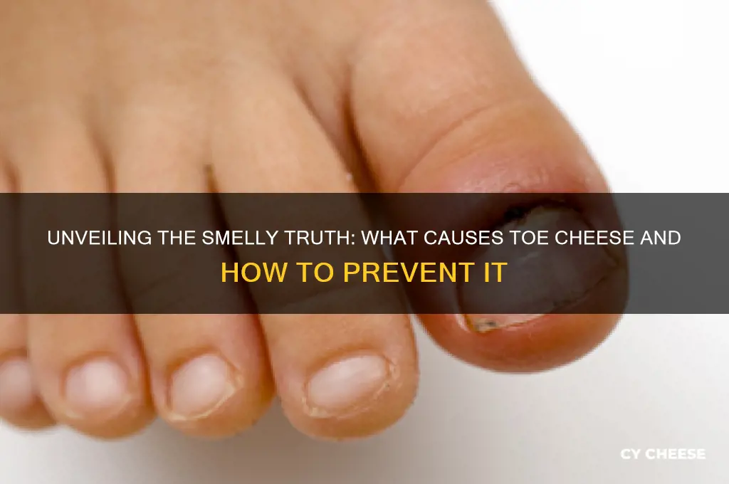 what causes toe cheese