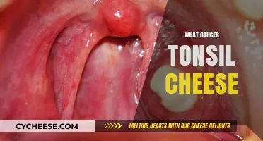 Understanding Tonsil Cheese: Causes, Symptoms, and Effective Treatment Options