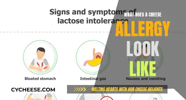 Cheese Allergy: Symptoms and Signs You Should Know