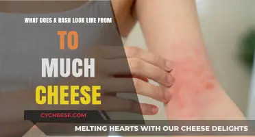 Cheese Overload: Identifying Rashes Caused by Excessive Cheese Consumption