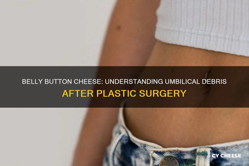 what is belly button cheese in plastic surgery