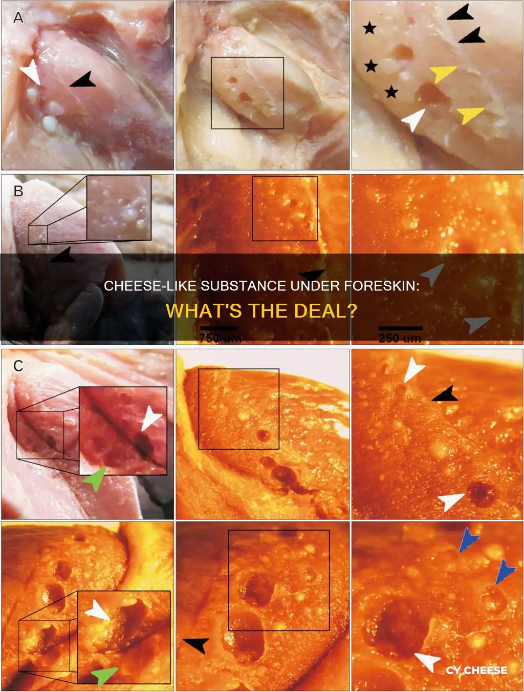 what is the cheese like substance under foreskin