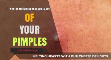 Pimple Cheese Explained: Understanding the White Substance in Your Skin