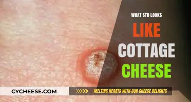 Cottage Cheese-Like STD Symptoms: What You Need to Know