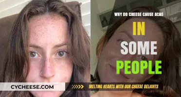 Cheese and Acne: Uncovering the Surprising Skin Connection