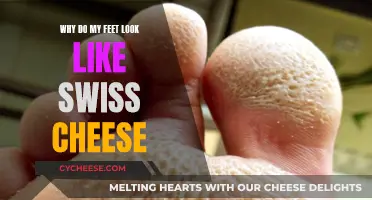 The Holes in My Feet: Swiss Cheese Syndrome