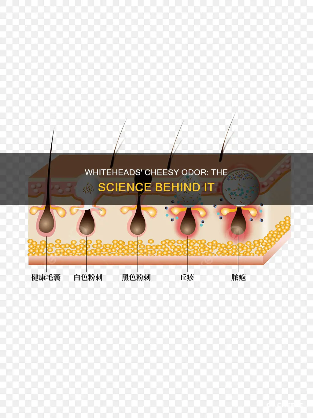 why do whiteheads smell like cheese