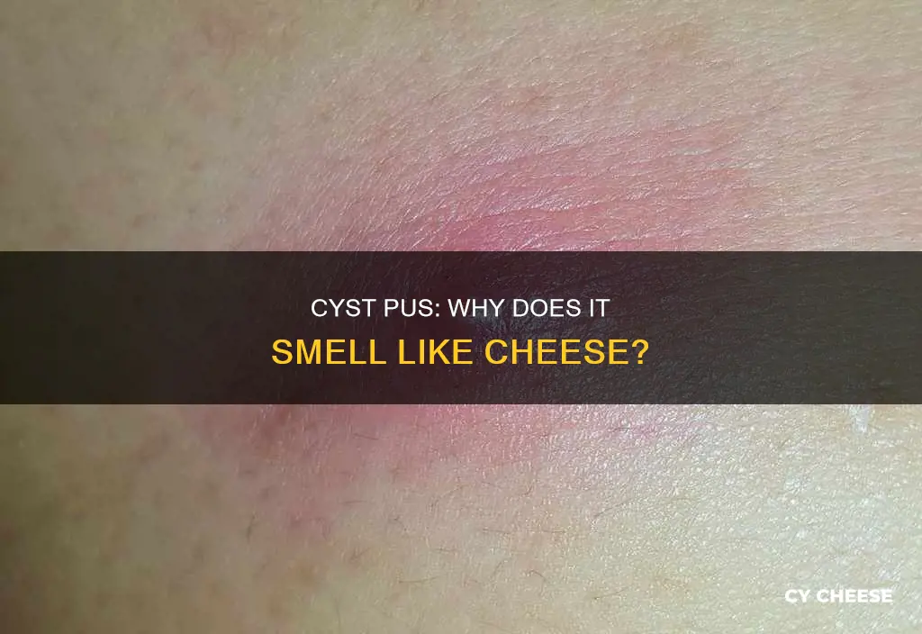 why does cyst pus smell like cheese