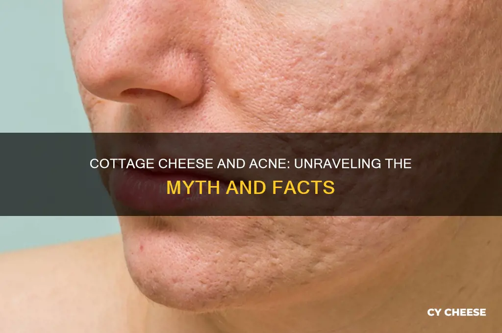 will cottage cheese cause acne