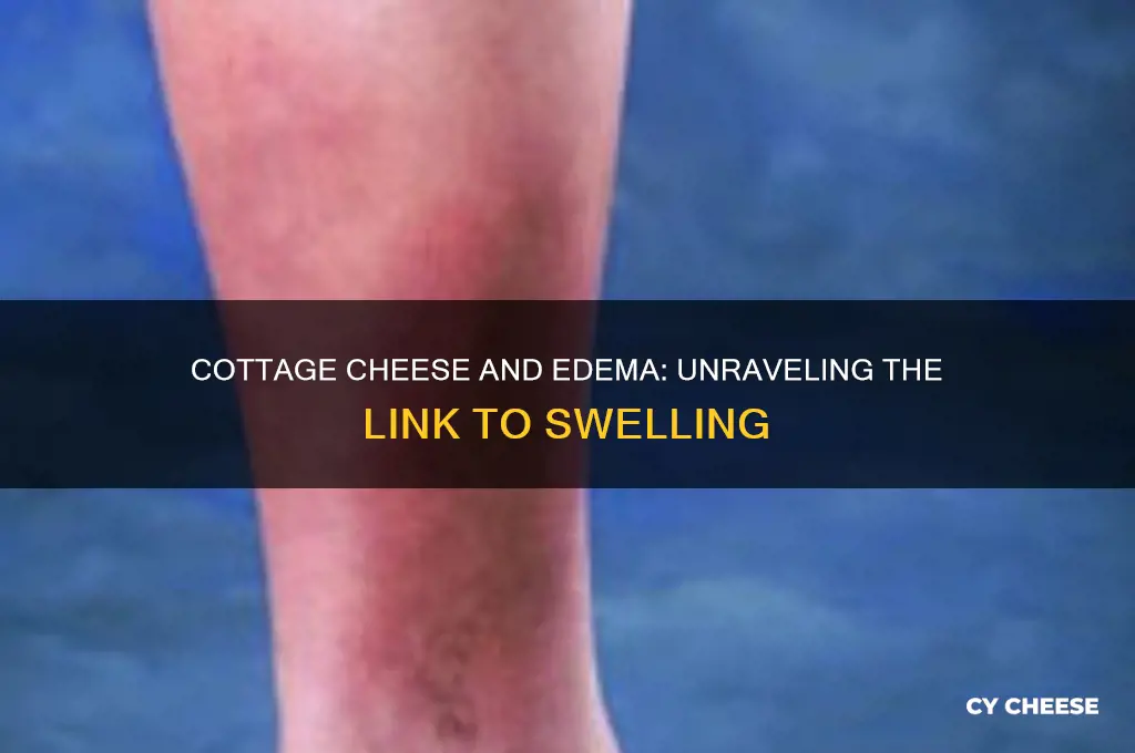 would cottage cheese cause edema